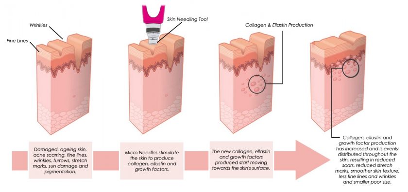 Collagen induction therapy